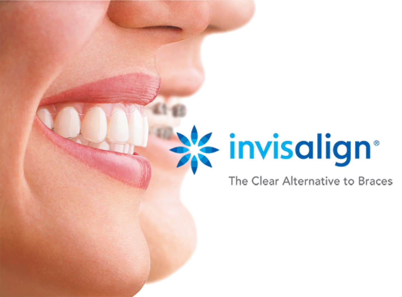 Invisalign bild